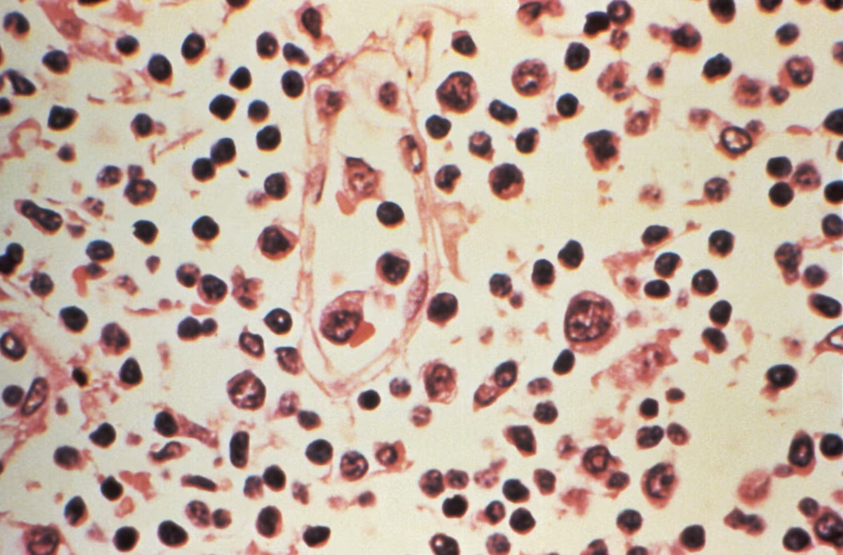 A sample from a patient infected with the hantavirus (Photo: Centers for Disease Control and Prevention/Handout via REUTERS)