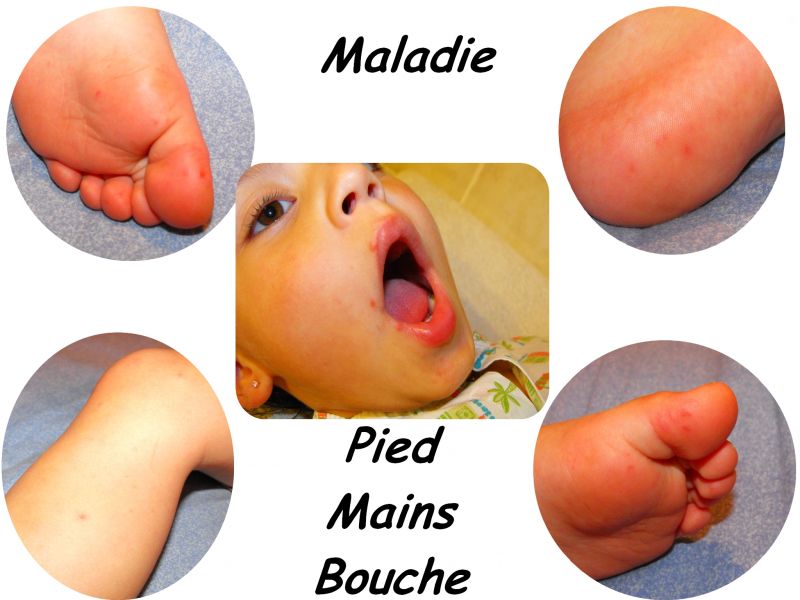 Déclenchement de la campagne nationale contre l’épidémie main-pied-bouche