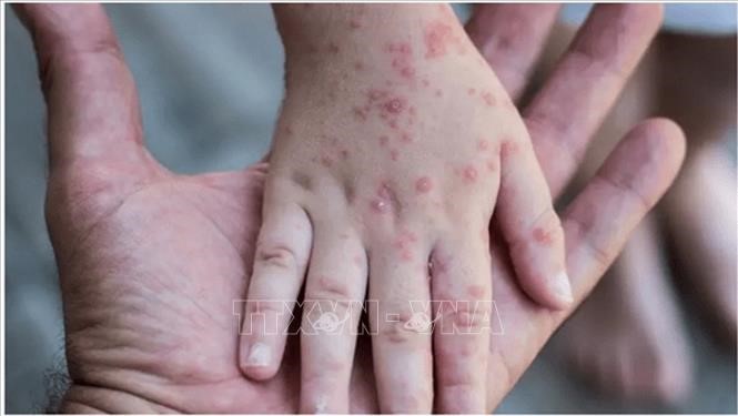 Weltgesundheitsorganisation: Affenpocken wird globale Medizin kaum beeinträchtigen