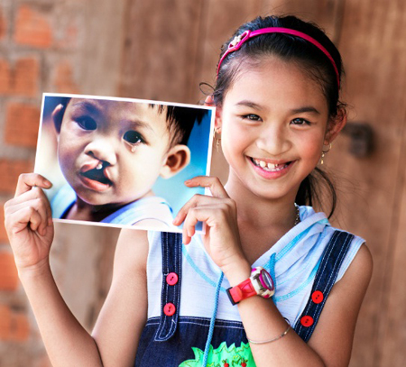 Asosiasi sumbing Jepang melakukan operasi gratis untuk 60 anak provinsi Ben Tre