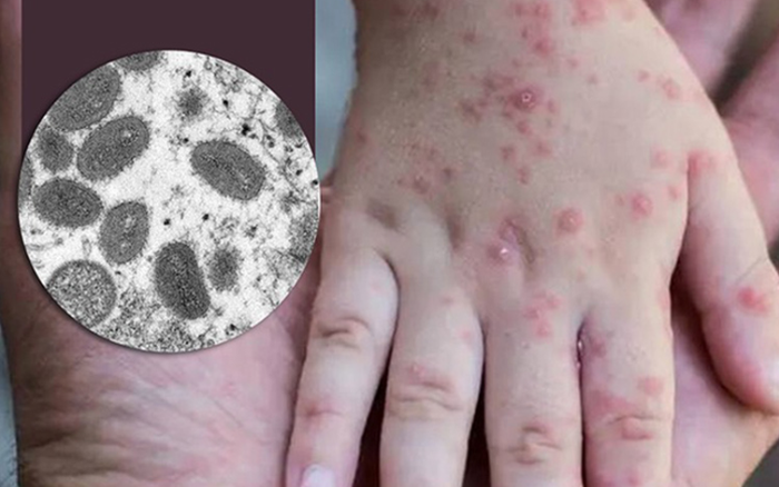 ВОЗ: Новых смертельных исходов у заболевших оспой обезьян ожидают в Европе