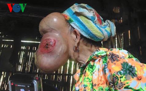 hy huu: ca benh chua tung gap tai viet nam hinh 0