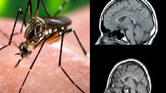 Confirman el primer caso importado de zika en embarazada en Europa