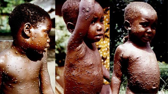 Мир прилагает усилия для борьбы с эпидемией оспы обезьян