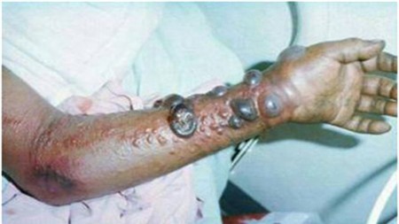 ຫຼາຍປະເທດເພີ່ມທະວີມາດຕະການຮັບມືກັບໂລກ Ebola ຊຶ່ງພວມແຜ່ລະບາດ